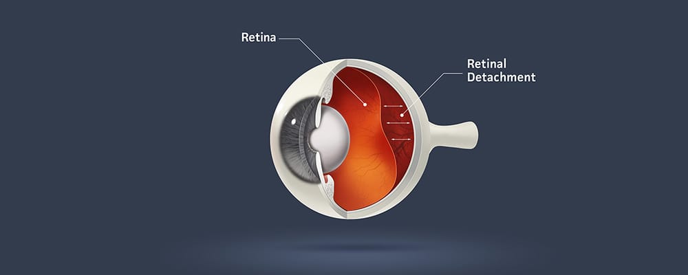 dechirure retinienne operation symptomes chirurgien ophtalmologue specialiste retine centre ophtalmologiste ophtalmologie paris est dechirure retinienne operation symptomes chirurgien ophtalmologue specialiste retine centre ophtalmologiste ophtalmologie paris est