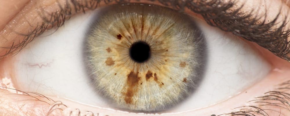 decollement du vitre et vision floue symptomes chirurgien ophtalmologue specialiste du vitre centre ophtalmologiste ophtalmologie paris est decollement du vitre et vision floue symptomes chirurgien ophtalmologue specialiste du vitre centre ophtalmologiste ophtalmologie paris est