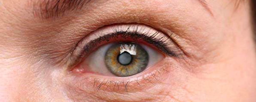 implant oculaire cataracte vision cause chirurgiens ophtalmologues paris centre ophtalmologique ophtalmologie paris est