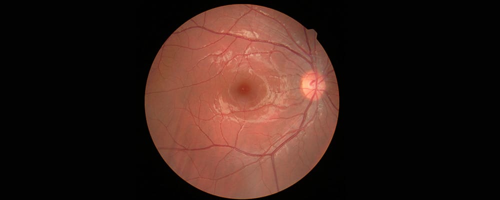 occlusion veineuse retinienne symptomes traitement causes chirurgien ophtalmologue specialiste retine centre ophtalmologiste ophtalmologie paris est occlusion veineuse retinienne symptomes traitement causes chirurgien ophtalmologue specialiste retine centre ophtalmologiste ophtalmologie paris est