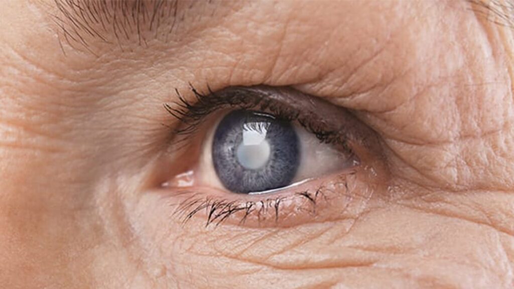 operation cataracte age limite implant chirurgiens ophtalmologues paris centre ophtalmologique ophtalmologie paris est