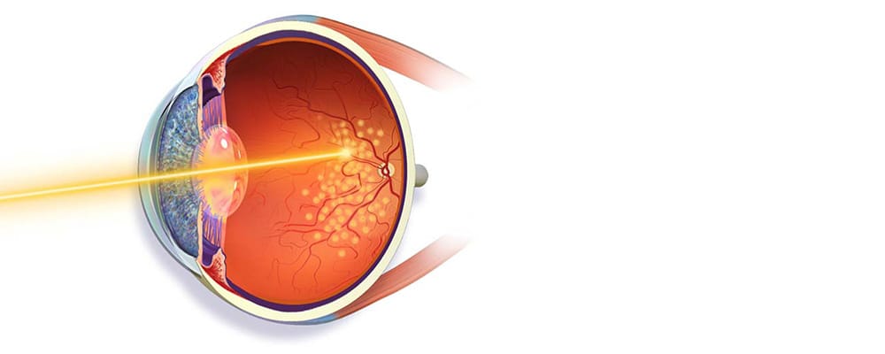 photocoagulation au laser retine effets secondaires chirurgien ophtalmologue specialiste de la retine centre ophtalmologiste ophtalmologie paris est photocoagulation au laser retine effets secondaires chirurgien ophtalmologue specialiste de la retine centre ophtalmologiste ophtalmologie paris est