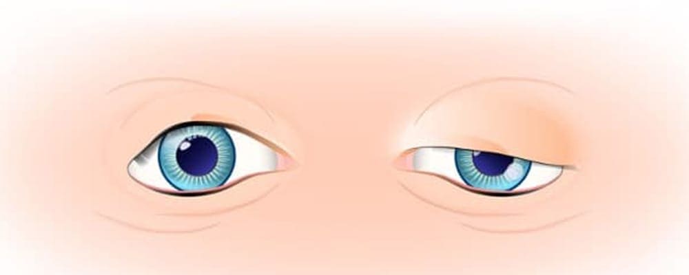 ptosis definition oeil causes chirurgien ophtalmologue specialiste paupiere centre ophtalmologiste ophtalmologie paris est ptosis definition oeil causes chirurgien ophtalmologue specialiste paupiere centre ophtalmologiste ophtalmologie paris est