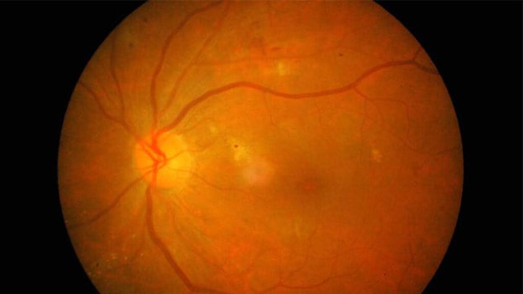 la retine yeux definition chirurgien ophtalmologue specialiste retine centre ophtalmologiste ophtalmologie paris est