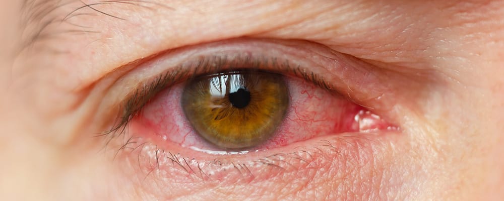 peut on vivre longtemps avec un glaucome oeil operation chirurgien ophtalmologue specialiste glaucome centre ophtalmologiste ophtalmologie paris est peut on vivre longtemps avec un glaucome oeil operation chirurgien ophtalmologue specialiste glaucome centre ophtalmologiste ophtalmologie paris est