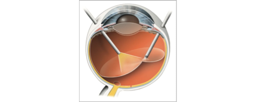 chirurgie de la retine oeil vitrectomie chirurgien ophtalmologue specialiste de la retine centre ophtalmologiste ophtalmologie paris est chirurgie de la retine oeil vitrectomie chirurgien ophtalmologue specialiste de la retine centre ophtalmologiste ophtalmologie paris est