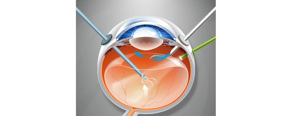 corps flottant dans les yeux chirurgien ophtalmologue specialiste de la retine centre ophtalmologiste ophtalmologie paris est corps flottant dans les yeux chirurgien ophtalmologue specialiste de la retine centre ophtalmologiste ophtalmologie paris est