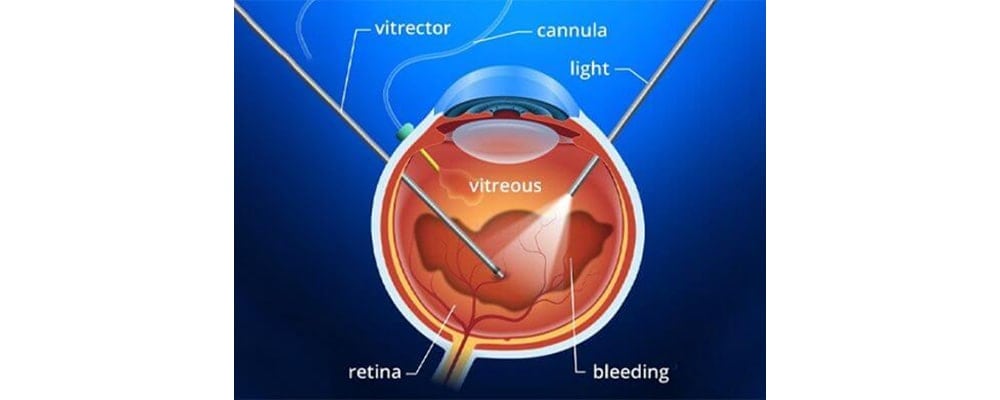 hemorragie intravitreenne stade chirurgien ophtalmologue specialiste retine centre ophtalmologiste ophtalmologie paris est hemorragie intravitreenne stade chirurgien ophtalmologue specialiste retine centre ophtalmologiste ophtalmologie paris est