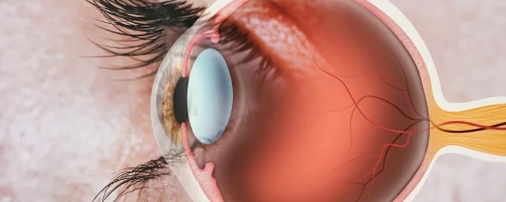 operation de la retine avis chirurgien ophtalmologue specialiste de la retine centre ophtalmologiste ophtalmologie paris est operation de la retine avis chirurgien ophtalmologue specialiste de la retine centre ophtalmologiste ophtalmologie paris est