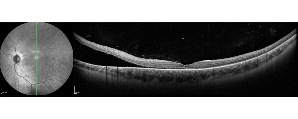 tomographie en coherence optique decollement de retine inferieure sans dechirure identifiee chirurgien ophtalmologue specialiste retine centre ophtalmologiste ophtalmologie paris est tomographie en coherence optique decollement de retine inferieure sans dechirure identifiee chirurgien ophtalmologue specialiste retine centre ophtalmologiste ophtalmologie paris est
