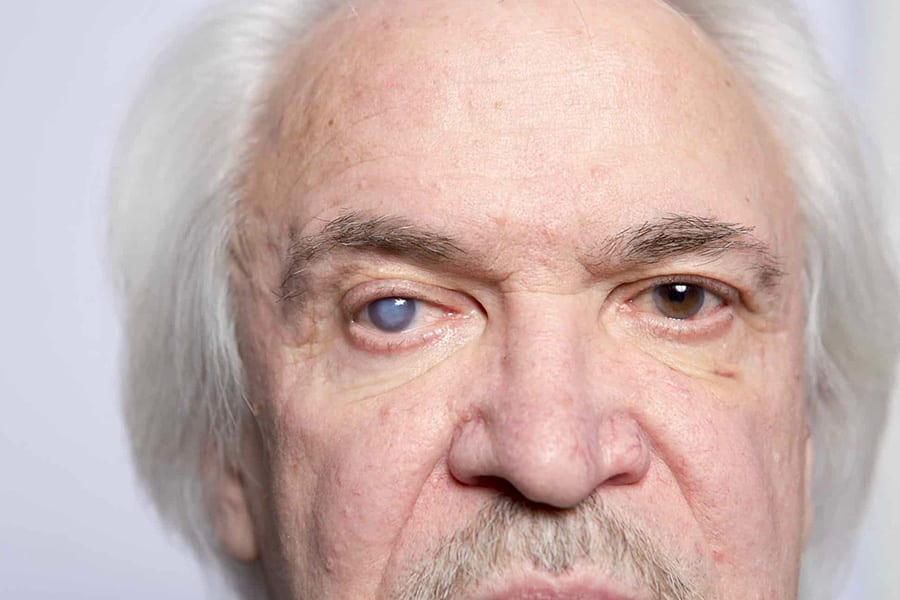 Peut-on changer un implant de cataracte ?