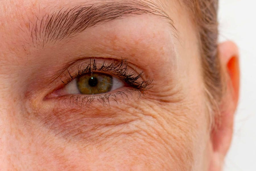 botox pattes d oie chirurgien ophtalmologue specialiste cataracte centre ophtalmologiste ophtalmologie paris est