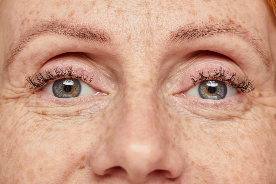ride patte d oie age botox medecine ophtalmologie esthetique chirurgiens ophtalmologues paris centre ophtalmologique ophtalmologie paris est ride patte d oie age botox medecine ophtalmologie esthetique chirurgiens ophtalmologues paris centre ophtalmologique ophtalmologie paris est