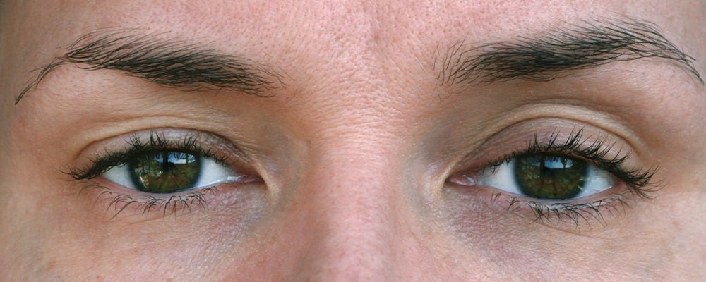 chirurgie du ptosis paris chirurgien ophtalmologue chirurgie paupiere centre ophtalmologiste ophtalmologie paris est chirurgie du ptosis paris chirurgien ophtalmologue chirurgie paupiere centre ophtalmologiste ophtalmologie paris est